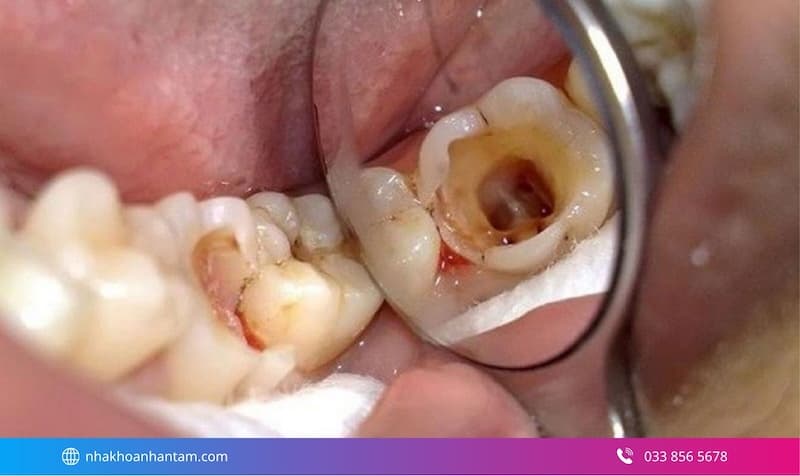 điều trị tủy răng sâu